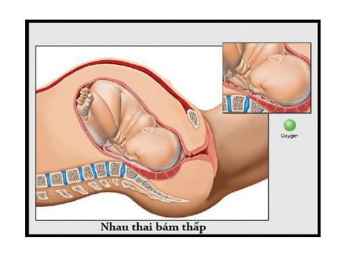 Biến chứng cực nguy hiểm trong thai kỳ - 5